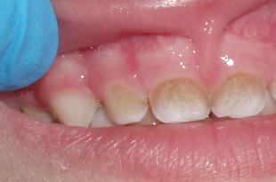 Желтый налет на зубах у ребенка — в каких случаях можем справиться сами, а когда стоит сразу идти к врачу